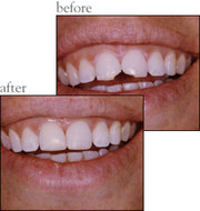 Cosmetic Dentist in Colorado