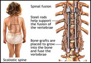 Scoliosis Surgery at Delhi  – India at Affordable Cost