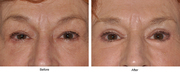 blepharoplasty Surgery