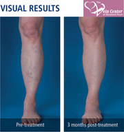 Vein Disease Treatments at Maryland,  USA