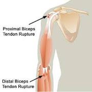 Shoulder Pain Treatment Irving