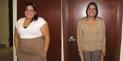 Lose Weight through Abdominoplasty Wisconsin