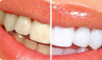 Zoom Teeth whitening Appleton Fox Valley Green Bay Neenah