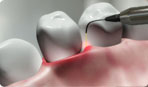 Dental Laser Therapy Appleton Fox Valley Green Bay Neenah