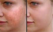 Fraxel laser skin resurfacing