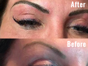 Eyebrow Micro balding