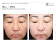 Halo Hybrid Fractional Laser Treatment in Orlando