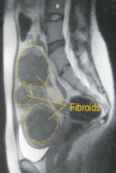 Seckin Endometriosis Center