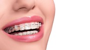 Get the best Ceramic Braces in Colorado Springs!