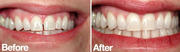 Teeth Whitening - Dental Lounge karama,  Dubai