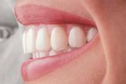 Best Invisible Braces Colorado Springs!