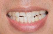 Smile Makeover Treatment in Sacramento 