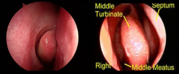 Sinus Treatment in Los Angeles