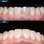 Porcelain Dental Veneers in Brooklyn