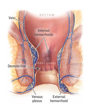 Hemorrhoid Treatment in NYC