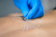 Dry Needling Treatment Houston